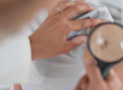 Odstránenie znamienok, bradavíc alebo tetovania. Predíďte prípadným starostiam a nechajte si ich odstrániť alebo sa zbavte bradavíc. 