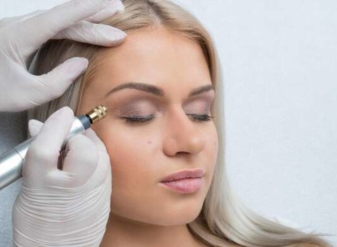 Fibroblast - nechirurgický lifting očného okolia alebo odstránenie vrások okolo očí, úst či na čele.