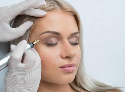 Fibroblast - nechirurgický lifting očného okolia alebo odstránenie vrások okolo očí, úst či na čele.