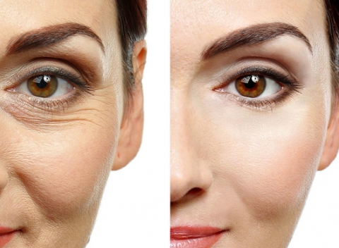 Fibroblast - neinvazívny lifting očných viečok a vrások. Rýchle a takmer bezbolestné.