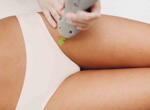 Laserová epilácia – najúčinnejšia metóda trvalého odstraňovania chĺpkov.