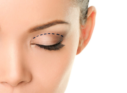 Plastická operácia padnutých viečok s 3D vizualizáciou – mladistvý pohľad ako kedysi.