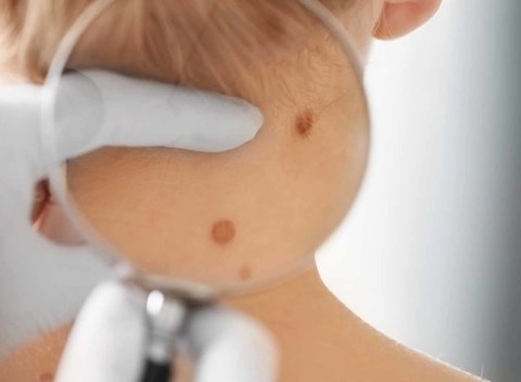 Preventívne dermatoskopické vyšetrenie všetkých materských znamienok na tele.