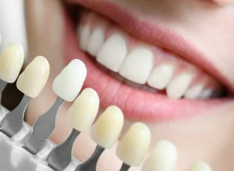 Bezpečné laserové bielenie zubov s nulovým obsahom peroxidu v salóne Brilliant Smile