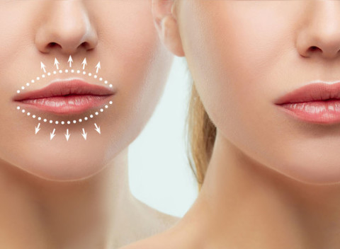 Zväčšenie pier a výplň vrások bez injekcií s Hyaluron pen v IM STUDIO.