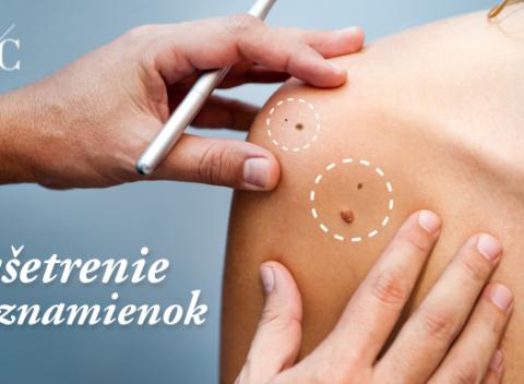 Zachráňte si život vyšetrením znamienok. Dôležitá prevencia dermatoskopickým vyšetrením najmodernejšou technológiou Fotofinder Body.