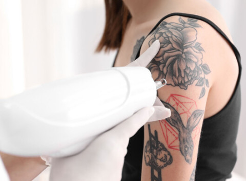 Odstránenie farebného i čiernobielého tetovania laserom v Inkfamous tattoo gallery.